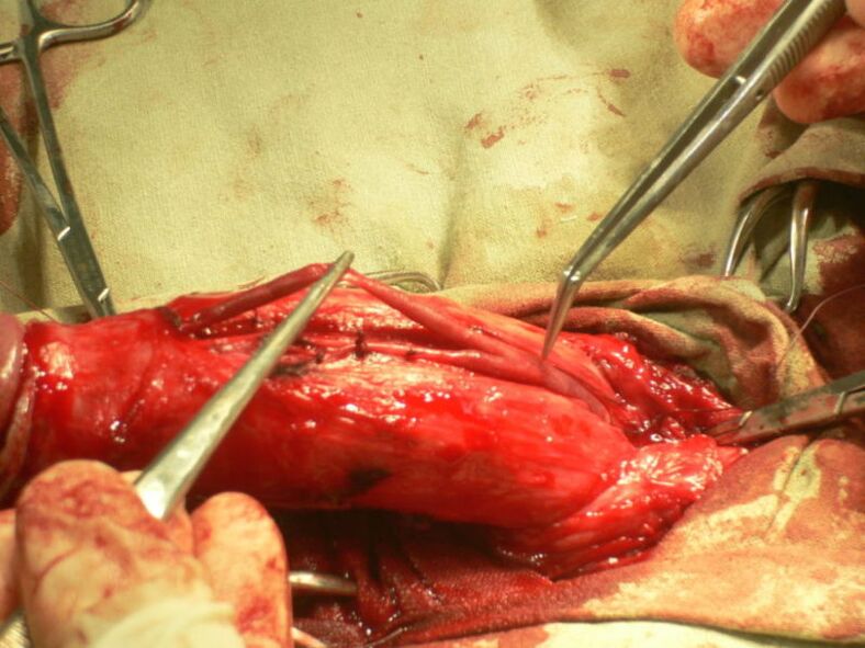 Lipofilling του πέους για μεγέθυνση