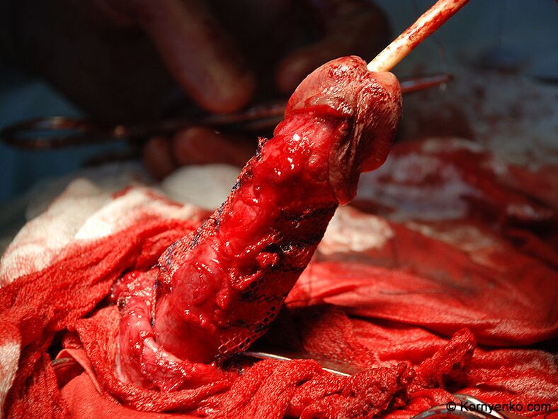 Εγκατάσταση μήτρας κολλαγόνου για μεγέθυνση πέους