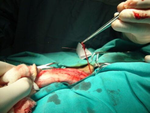 Χειρουργική διεύρυνσης πέους