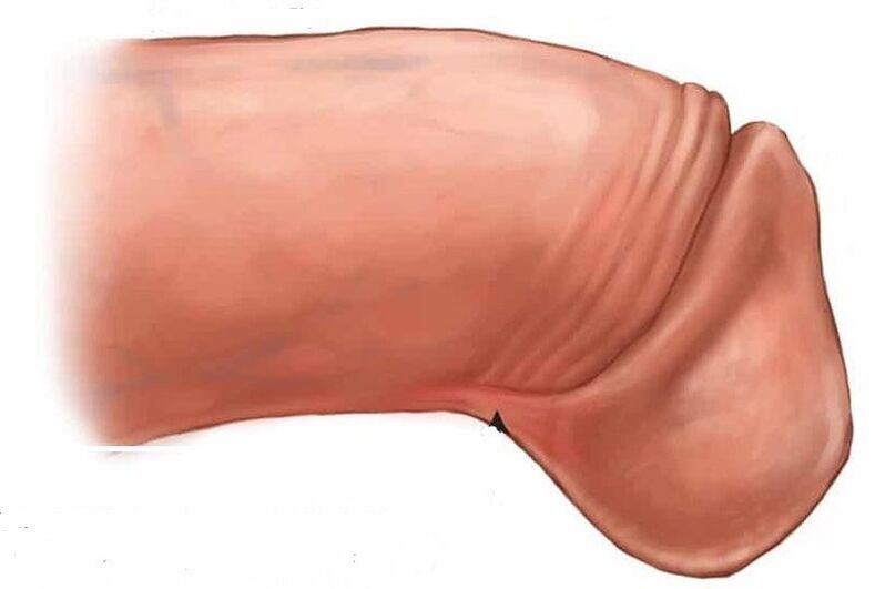 πώς να μεγεθύνετε τη βάλανο